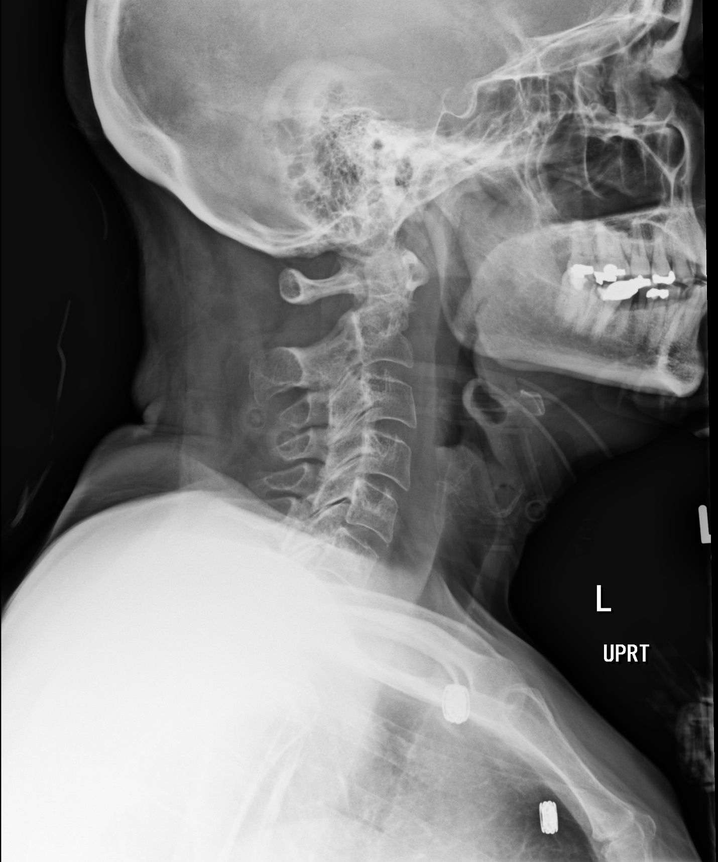 Cervical X Ray